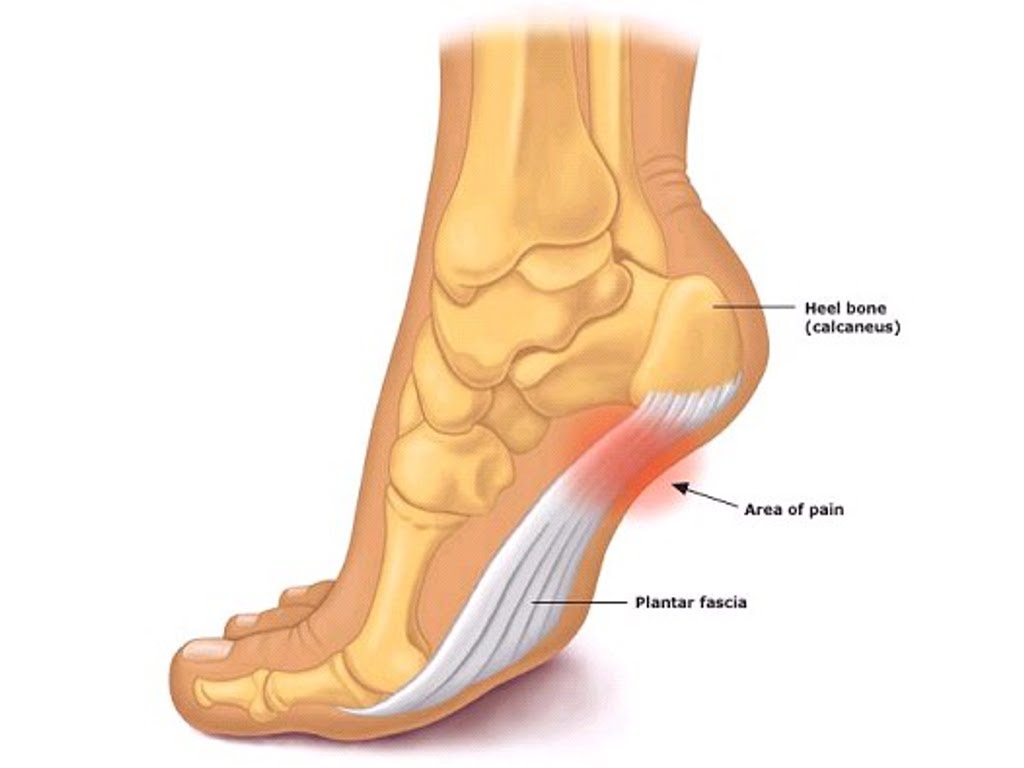Heel Pain (Plantar Fascitis) - Pune Foot Ankle