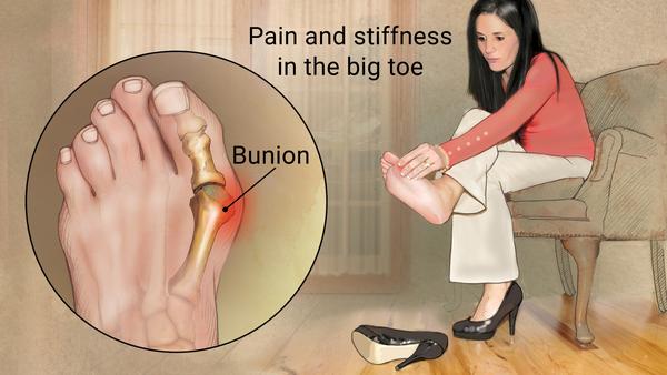 are sas shoes good for bunions