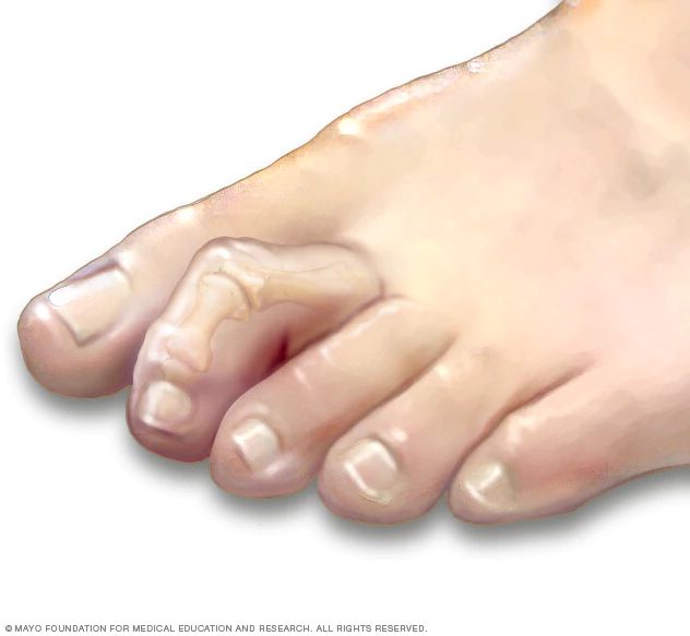 Dry, Cracked Feet: Causes and Remedies