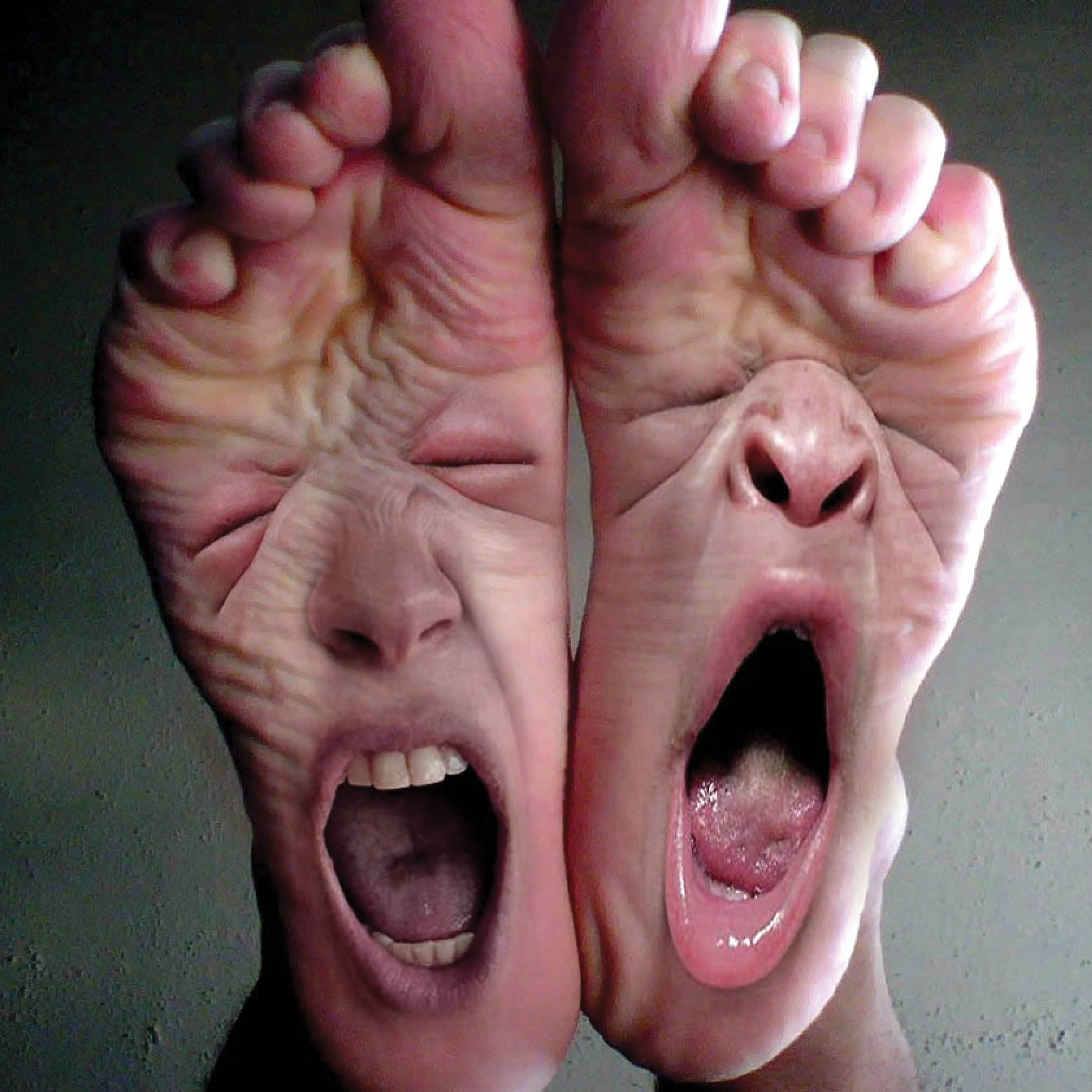 PLANTAR FASCIITIS
